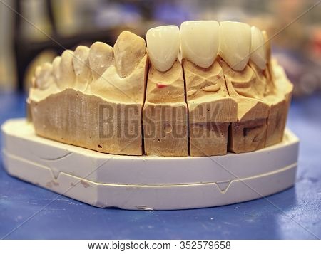 Ceramic-metal Crowns And Partial  Ceramic-metal Bridge. Replacement Of Artificial Tooth. Orthopedic 