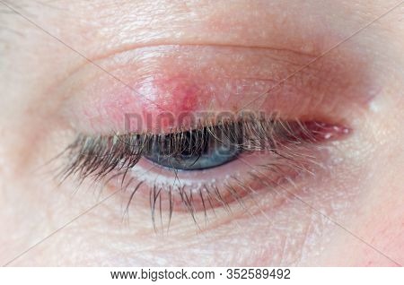 Chalazion On The Eyelid Of A Man Close-up.