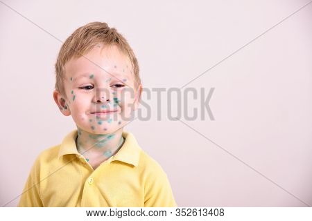 Young Toddler,boy With Chickenpox. Sick Child With Chickenpox. Varicella Virus Or Chickenpox Bubble