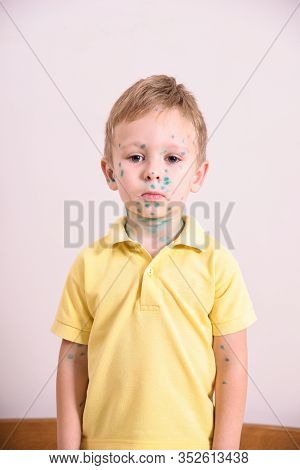 Young Toddler,boy With Chickenpox. Sick Child With Chickenpox. Varicella Virus Or Chickenpox Bubble