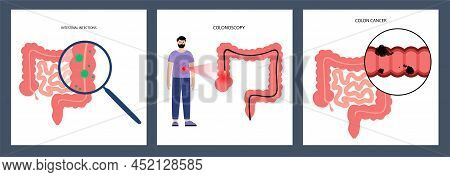 Colorectal Cancer And Viral Infections. Colonoscopy Procedure. Development Of Cancer From The Colon 