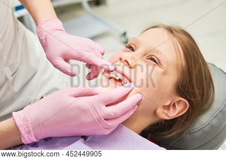 Braces for child teeth correction. Installation and maintenace