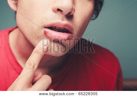 Young Man With Cold Sore