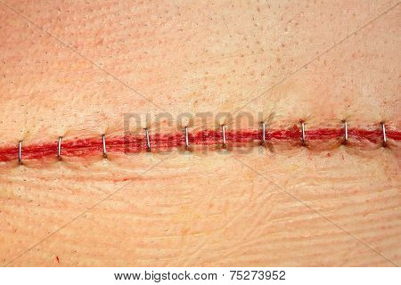 Modern Surgical Suture.