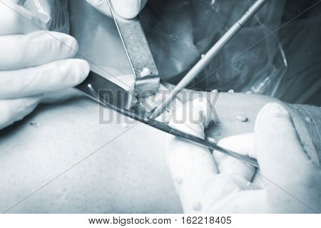Surgical Operation Knee Surgery