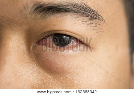 The human eye with symptoms of conjunctivitis