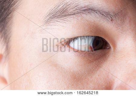 Close Up Of Ubconjunctival Hemorrhage In Eye