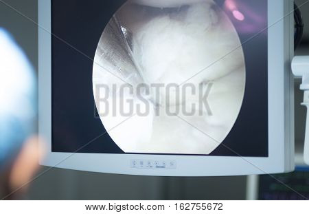 Arthroscopy Surgery Screen