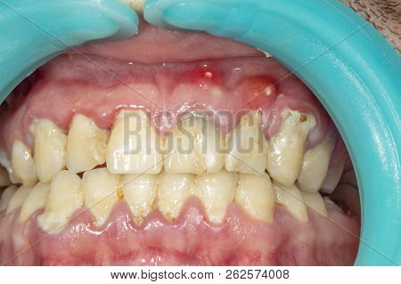Human Teeth Closeup With Dental Plaque And Inflammation Of Gingivitis. Concept Of Brushing Teeth And