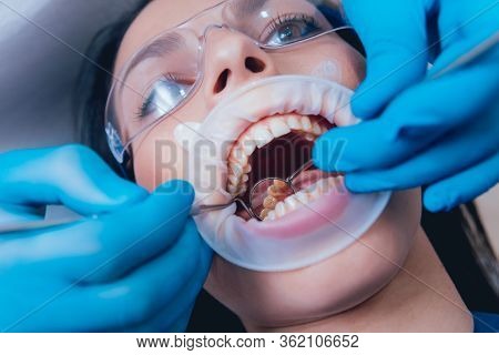 Dental Treatment With Expander. Modern Dental Technology