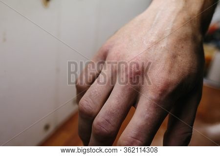 Psoriasis Skin. Psoriasis Is An Autoimmune Disease That Affects The Skin Cause Skin Inflammation Red