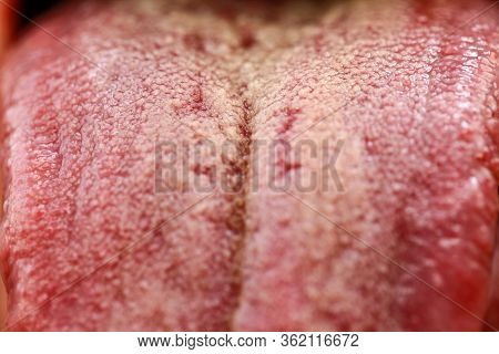 First Sign Of Coronovirus, Protruding White Plaque On Tongue, Macro