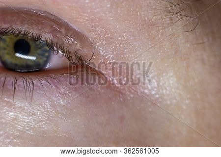 Inflamated Eye Infection. Red Bloody Eye Closeup Macro Result Of Allergies And Tiredness. Watery Red