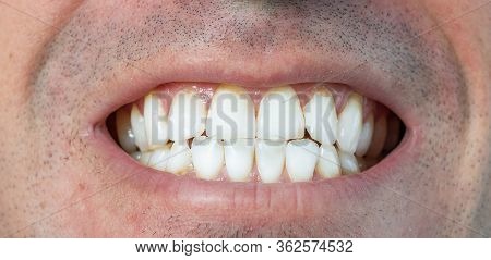 White Thooth - Smiing After Dentist - Clean