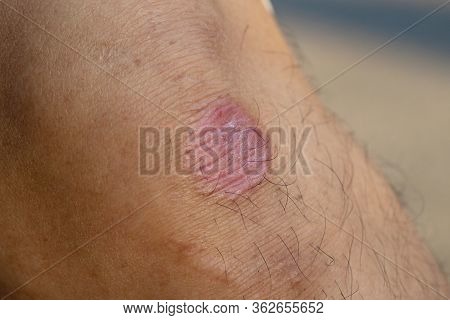 Ring Worm Infection, Dermatophytosis On Skin. Ringworm Infection Or Tinea On Skin. Mycosis Infection