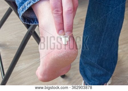 Man Does Ointment With Medication Or Cream With Moisturizing To Skin Of Feet Or Achilles Tendon. Pai
