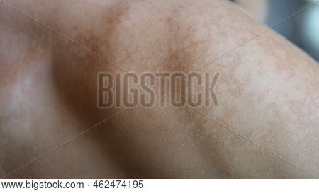 Skin Care Problem Spots On Shoulder Skin And Health Concept. Melasma Pigment Spots Dry Skin