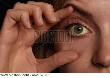 Woman Checking Her Health Condition, Closeup. Yellow Eyes As Symptom Of Problems With Liver