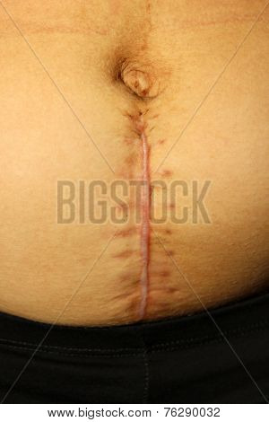 Seams After The Operation Of Caesarian Section