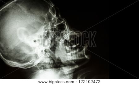 Film X-ray of normal human skull . lateral view . blank area at right side .