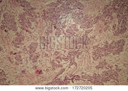 Cells of human breast tissue with cancer cells under the microscope.