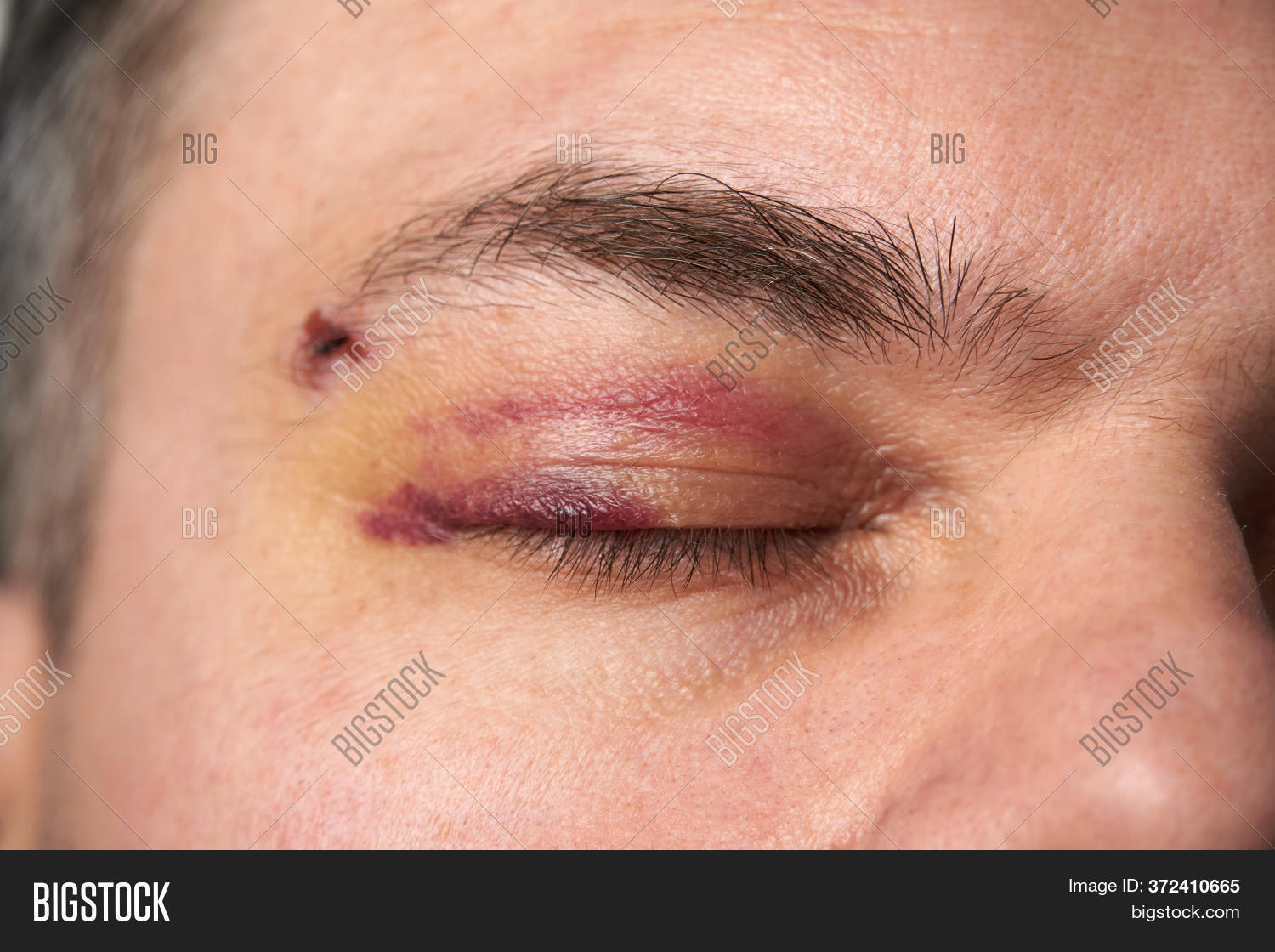 Close View Bruise Near Image & Photo (Free Trial) Bigstock