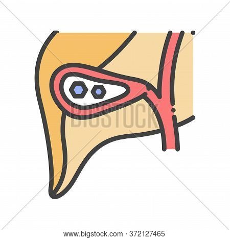 Pancreatic Stones. Acute Pancreatitis. Human Organ Concept. Sign For Web Page, Mobile App, Button, L