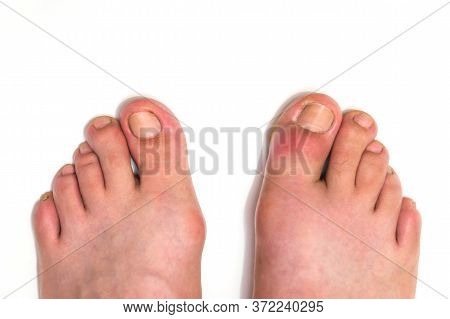 Gout Or Podagra On The Big Toe Appears As Redness And Unbearable Pain
