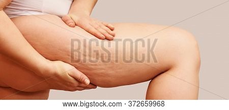 Cellulite Leg Woman Pinch. Test Fat Hips Treatment. Over Weight Liposuction. Remove Striae.
