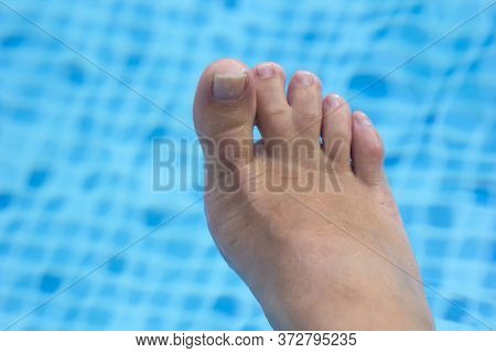 Webbed Toes, Woman Right Foot With Veins And Webbed Toes On Blue Pool Background. Genetic Disorders 