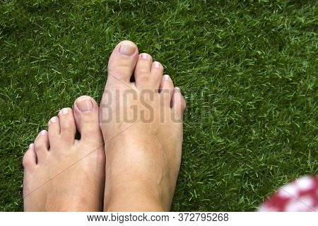 Top View Of Female Legs With Fused Middle Toes On Green Grass Background. Webbed Toes Genetic Disord
