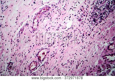 Breast Fibroadenosis, Light Micrograph, Photo Under Microscope. Common Benign Hyperplastic Process I
