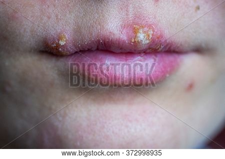 Herpes Disease On The Lips Of A Young Girl. Wounds From Herpes On The Lips Of A Person. Herpes Foci.