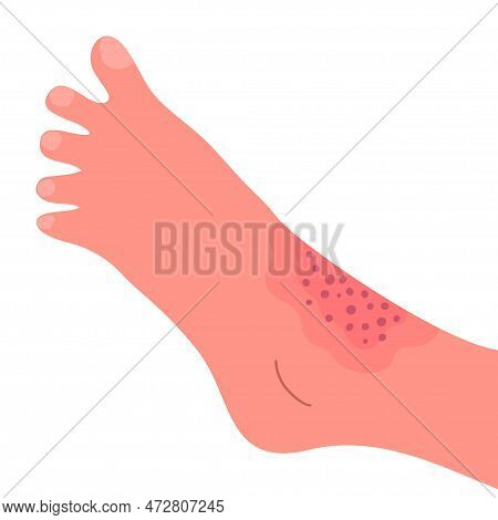Dermatitis On The Skin Of A Human Leg. Dermatological Disease. The Symptom Is Itching, Pain, Redness
