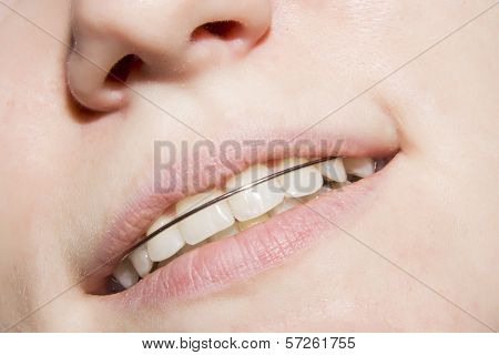 The Young Girl Smiling With Braces On Teeth