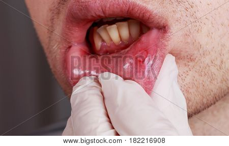 Stomatitis on the lips of a man