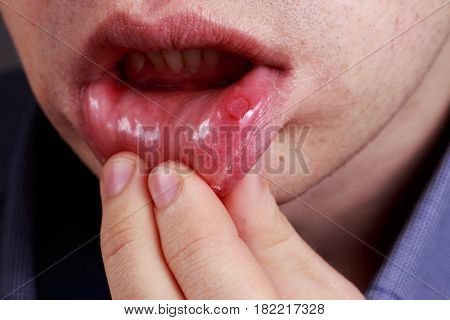 Stomatitis on the lips of a man