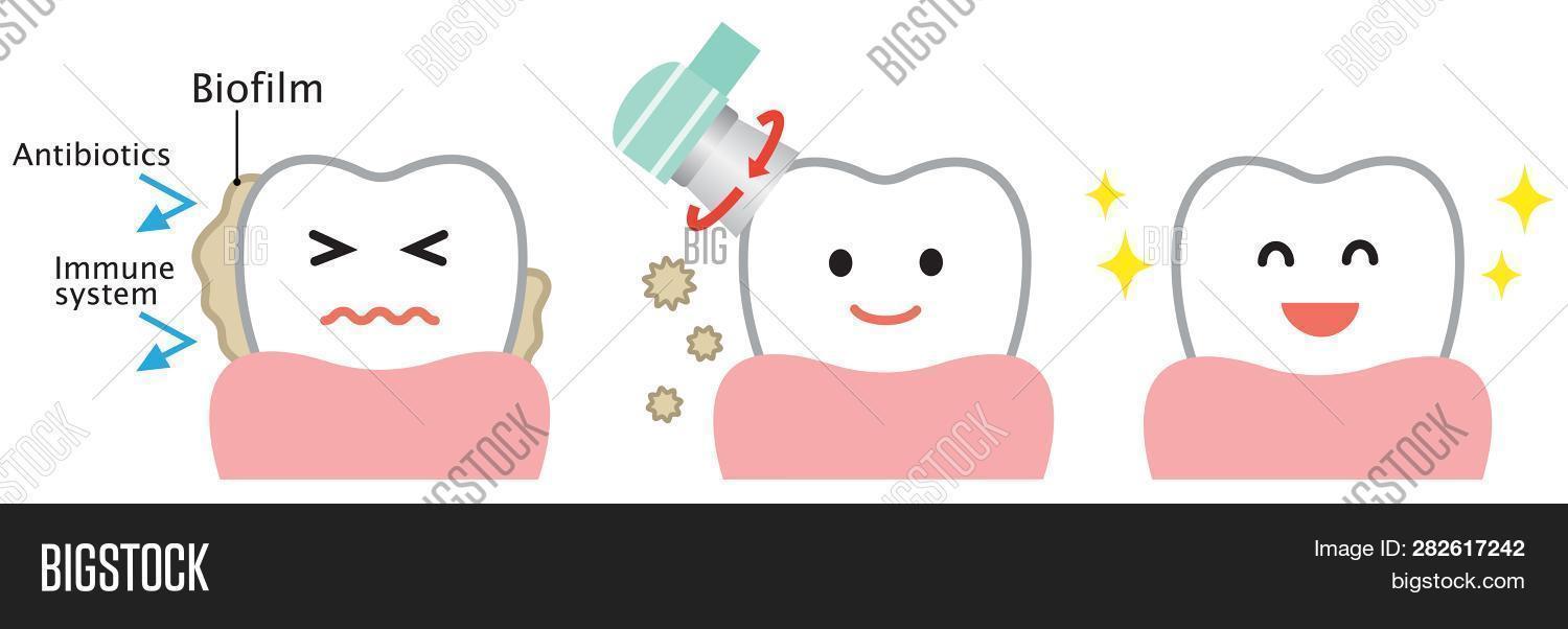 Dental Biofilm Removal Image & Photo (Free Trial) Bigstock