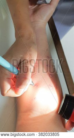 Arm Examine With Allergy Skin Prick Test Rash Reaction Aero Dust Mite Sensitive