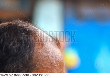 Close Up Photo Of A Bald Receding Hairline Of A Male. Hair Loss Male Patterned Baldness Concept Imag