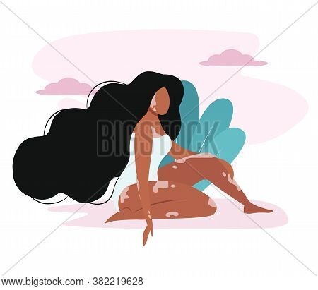 Vitiligo Day. Pretty Girl With Genetic Skin Problem. Natural Beauty. Self Love, Body Positive. Depig
