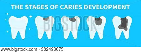 Cartoon Teeth Shows Stages Of Caries Development. Concept Of Gingivitis, Pulpitis And Periodontitis.