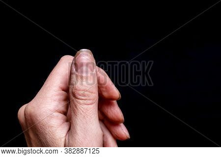 Close-up Of A Female Thumb With A Soft Fossa On A Nail, An Overgrown Cuticle, A Peeling Nail Layer, 