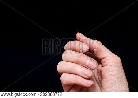 Close Up Of Dirty Black Brittle Nails, Broken Nails. Peeling On Nails. Nail And Hand Care Concept
