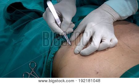 Doctor use a surgery blade open surgery areafat removal