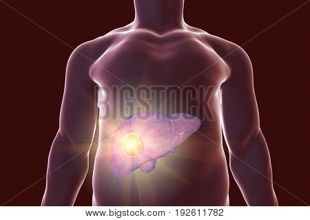 Liver cancer treatment. Conceptual image. 3D illustration