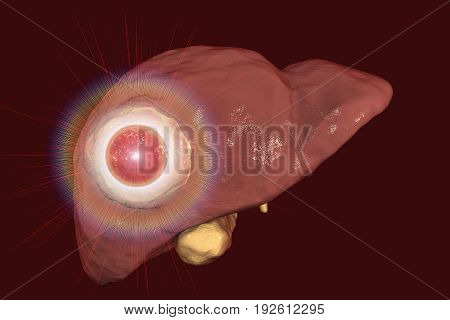 Liver cancer treatment. Conceptual image. 3D illustration