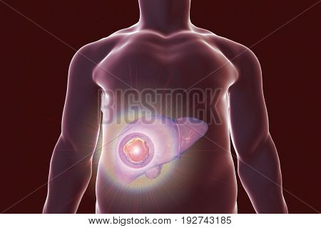 Liver cancer treatment. Conceptual image. 3D illustration