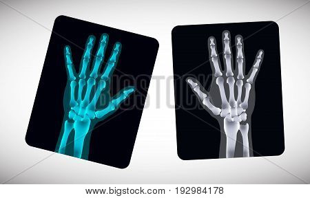 Radiography. Picture of human hands on the film. Vector illustration