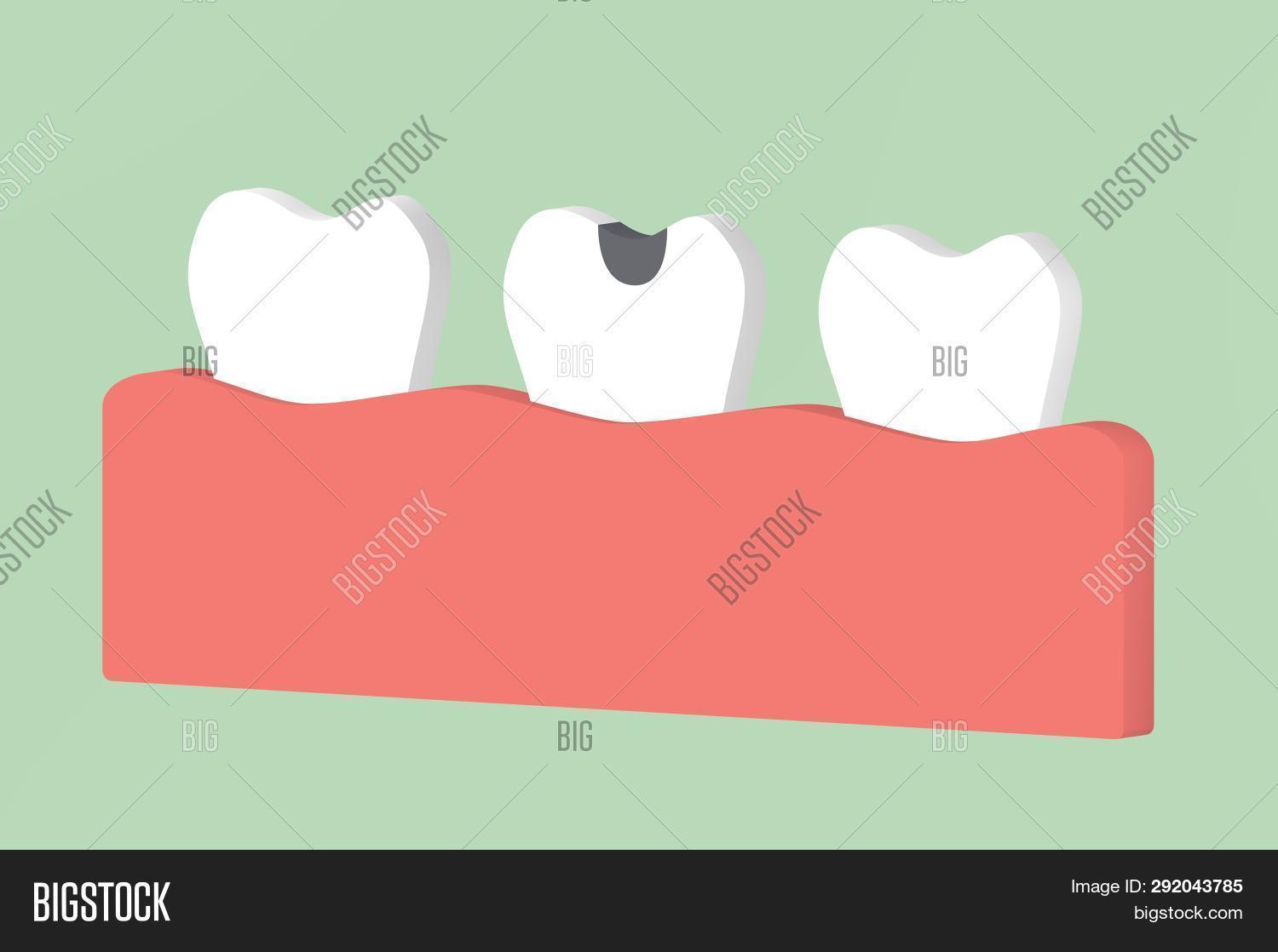 Debris Tooth Animation Decay Tooth Dental Image & Photo (Free Trial) | Bigstock